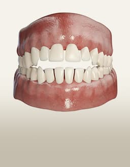 개방교합 턱관절교정